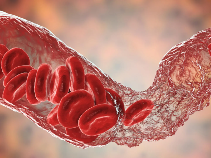 Breakthrough in understanding rare blood clotting after COVID-19 vaccines