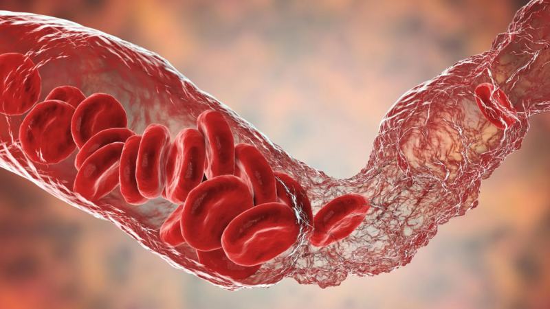 Breakthrough in understanding rare blood clotting after COVID-19 vaccines