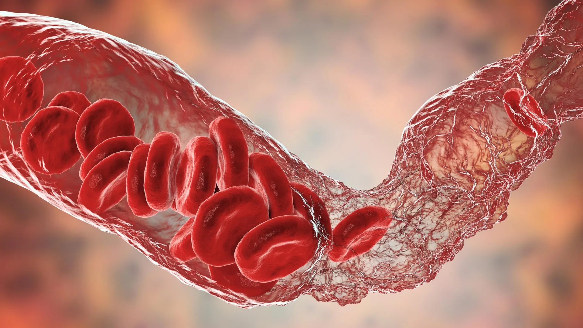 Breakthrough in understanding rare blood clotting after COVID-19 vaccines
